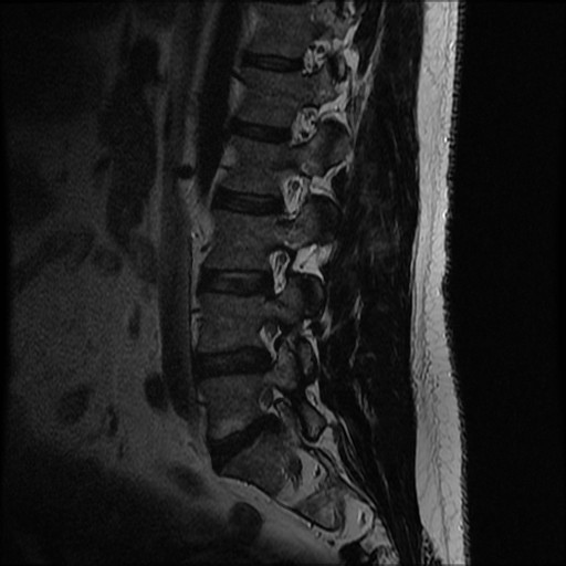 Herniated disc lateral Recess S1 nerve root compression